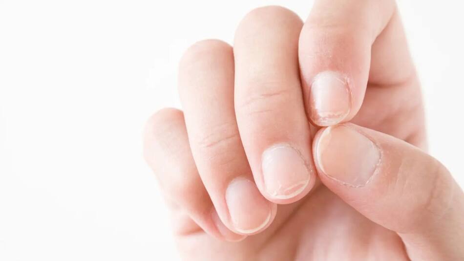 grietas en las uñas. Fuente: Captura