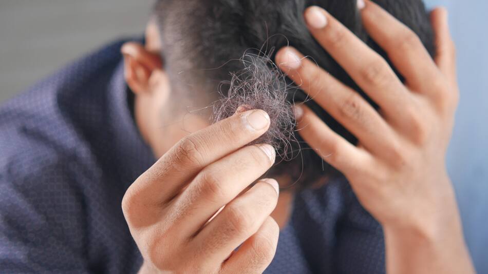 Alopecia, caída de cabello. Foto Unsplash.