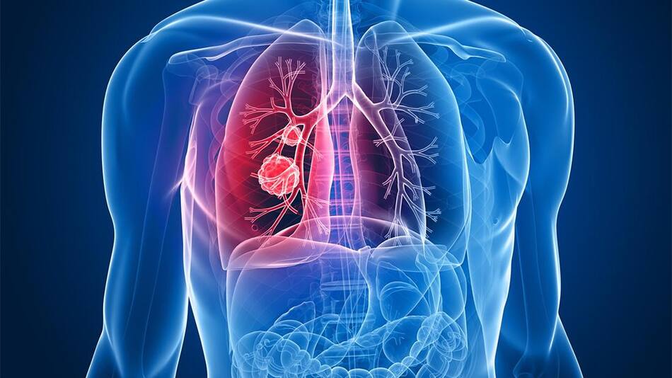 Cáncer de pulmón