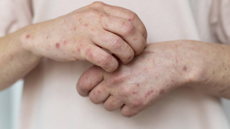 Todo sobre el Herpes Zoster y la vacuna para prevenir la culebrilla en mayores de 50 años. Foto Unsplash